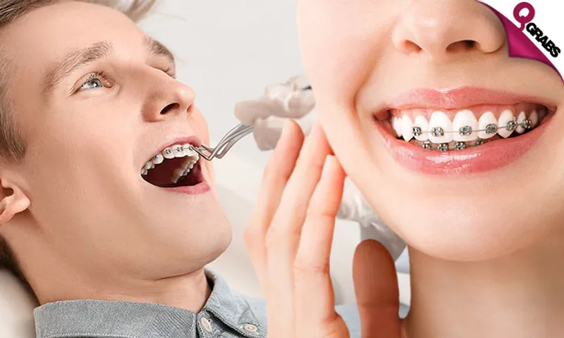 Metal Dental Braces!